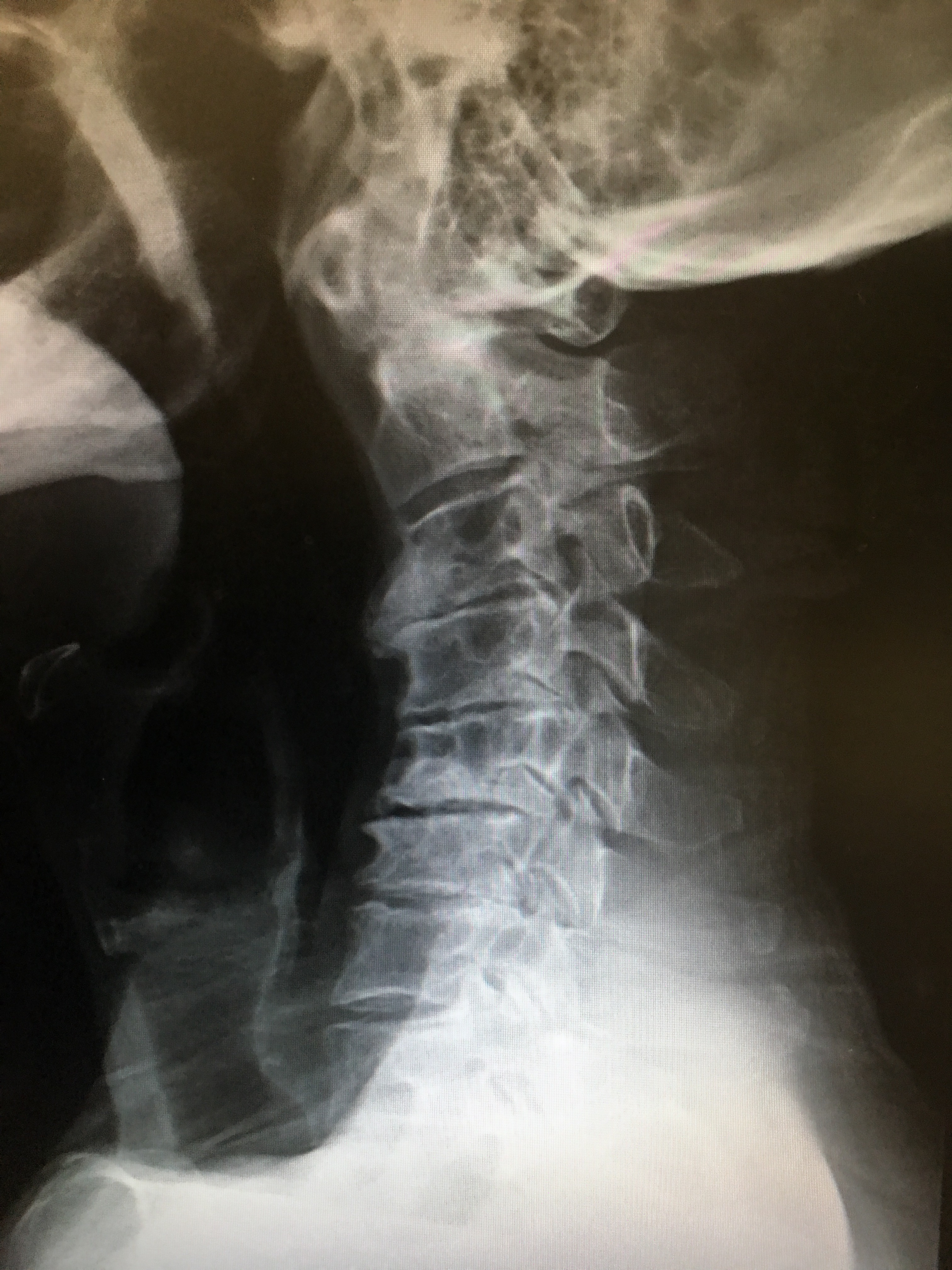 又一脊髓休克spinal shock